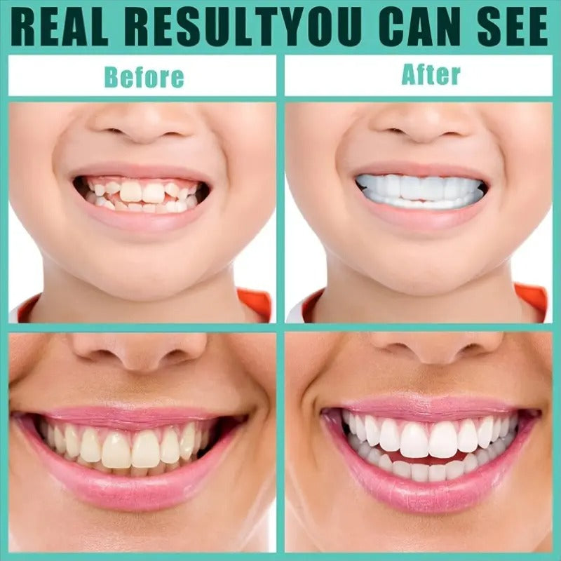 8pcs/4set Comfortflex White Dentures with Veneers - Unisex Upper And Lower Denture Care - Flexible And Comfortable, Lifelike, Dental Solutions, Dental Veneers Snap-On, Dental Veneers, Snap-On Veneers, Veneers, Gifts for Father And Mother