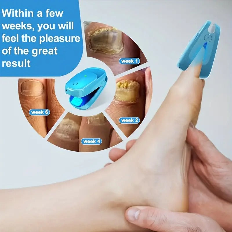 [Extra Strength KTS] KTS Nail Fungus Light Device | Extra Strength For Toenail, Fingernail With 407nm Blue Light & 905nm Light For Nail Fungus & Onychomycosis, At Home